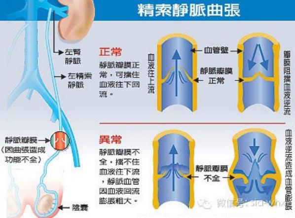 關(guān)于2021年征兵精索靜脈曲張標(biāo)準(zhǔn)的探討，2021年征兵精索靜脈曲張標(biāo)準(zhǔn)深度解析