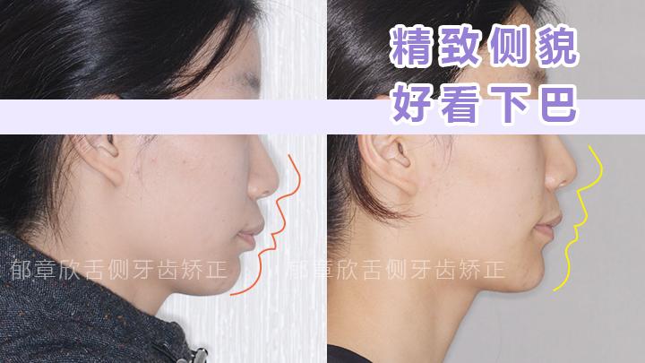 下巴后縮矯正方法詳解，下巴后縮矯正方法全面解析