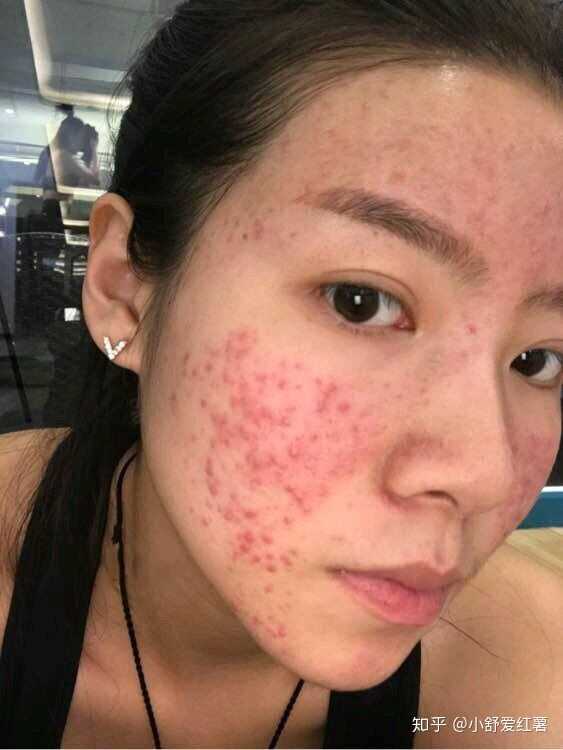 如何有效去除臉上的痘印——全方位指南，全方位指南，如何有效去除臉上痘印的方法