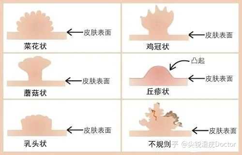 女性如何自己判斷真假尖銳濕疣？，女性如何自主辨別真假尖銳濕疣？