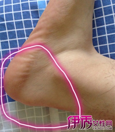 腳后跟疼的原因及治療方法，全面解析與應(yīng)對之道，腳后跟疼痛解析，成因、治療方法與應(yīng)對之道