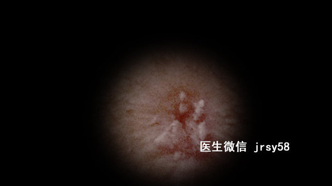 尖銳濕疹，深入了解與治療建議，尖銳濕疹，深度解析與治療指南