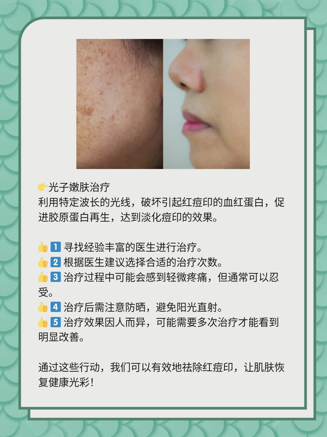 如何有效去除紅痘印，一站式解決方案，一站式解決紅痘印問題，有效去除方法大全