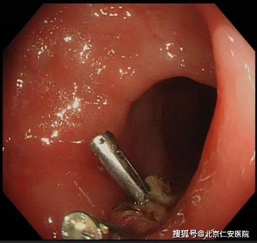 胃腸鏡檢查后悔死了？了解真相，消除疑慮，揭秘胃腸鏡檢查真相，消除疑慮，避免后悔！