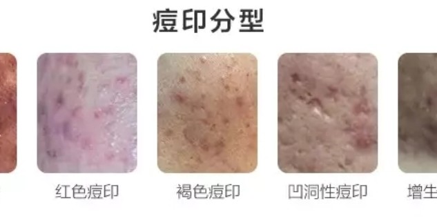 怎樣去痘印效果最好的方法，揭秘最佳去痘印方法，告別臉部瑕疵！