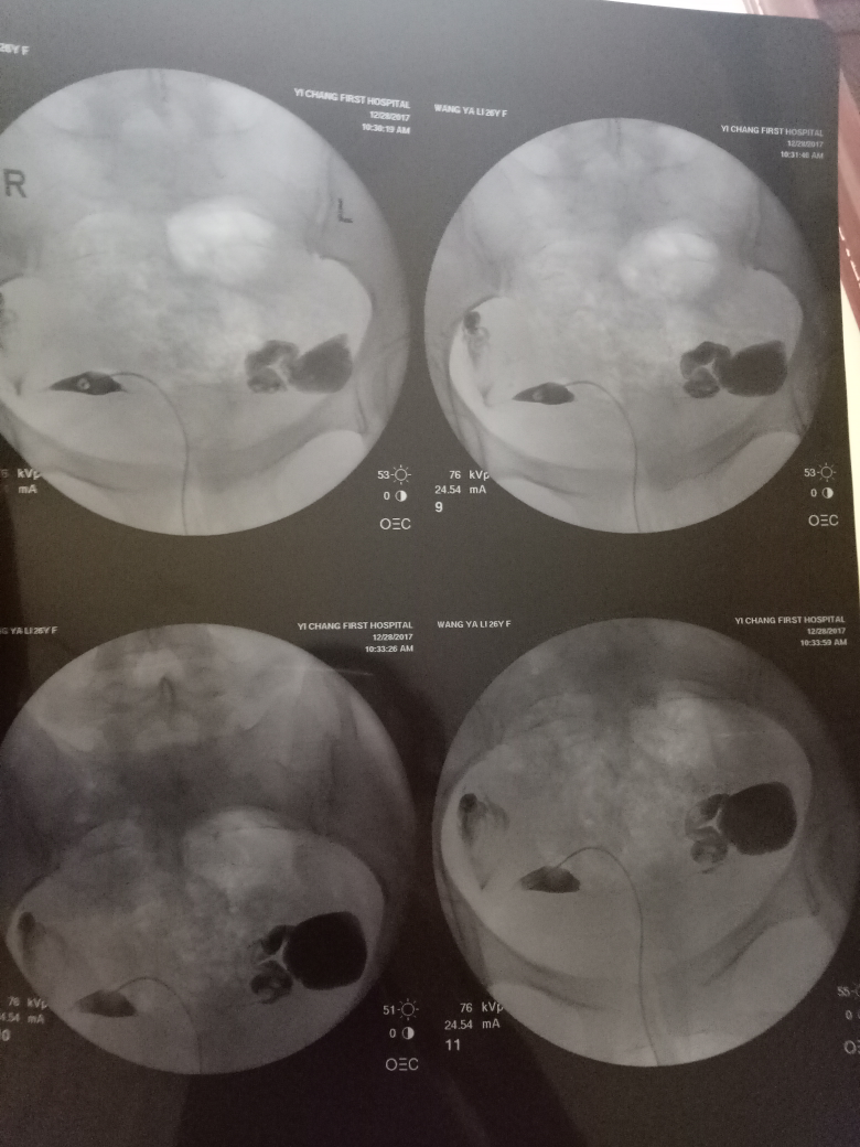 造影第二個(gè)月懷孕，機(jī)會(huì)與準(zhǔn)備，造影后第二個(gè)月懷孕的機(jī)會(huì)與準(zhǔn)備事項(xiàng)